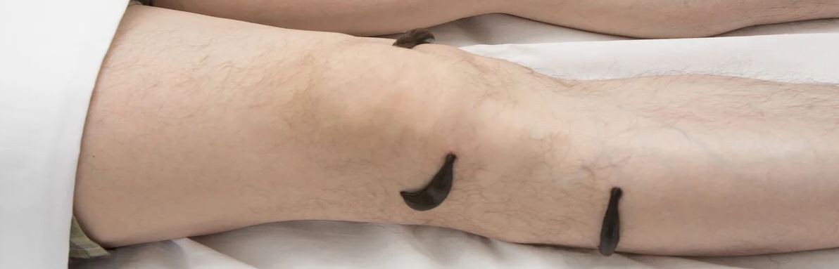 varices y sanguijuelas